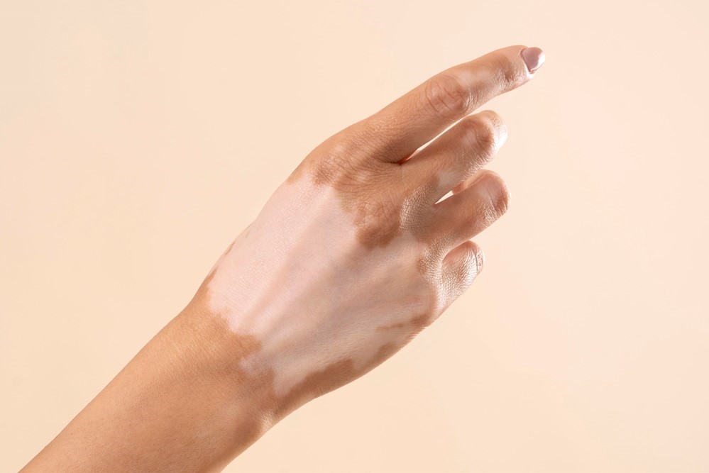Apakah Vitiligo? Ketahui Punca dan Gejala