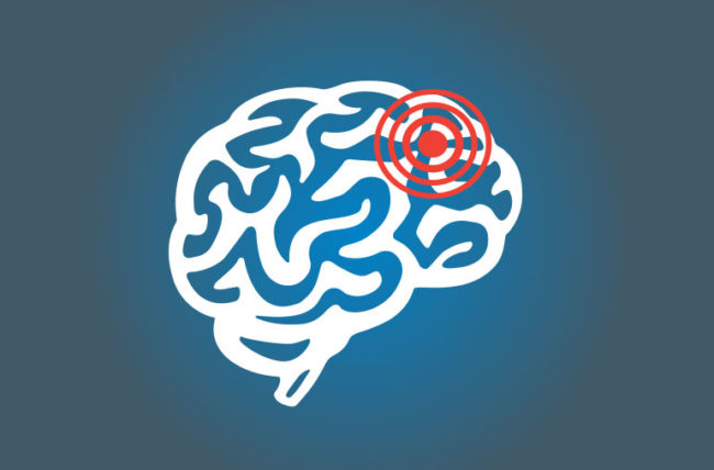 Benarkah Gejala Aneurisma Otak Mirip Dengan Stroke?